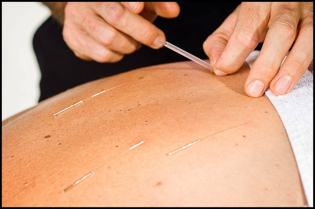 Japanese Acupuncture