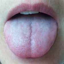 pale swollen tongue