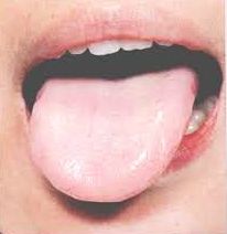 Pale Tongue