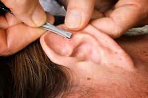 Ear Acupuncture Treatment 